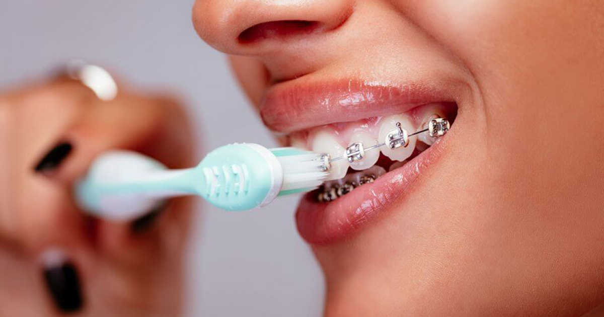 Có nên sử dụng nước súc miệng sau khi niềng răng không?
