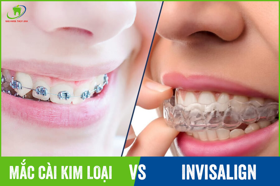 Nên chọn niềng răng invisalign hay niềng răng mắc cài?