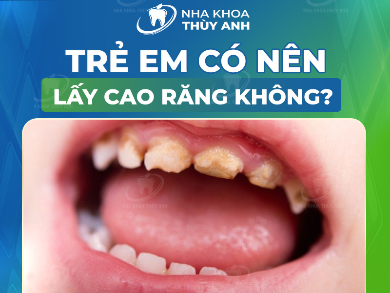 Trẻ em có nên lấy cao răng không? Lấy cao răng có nguy hiểm không?