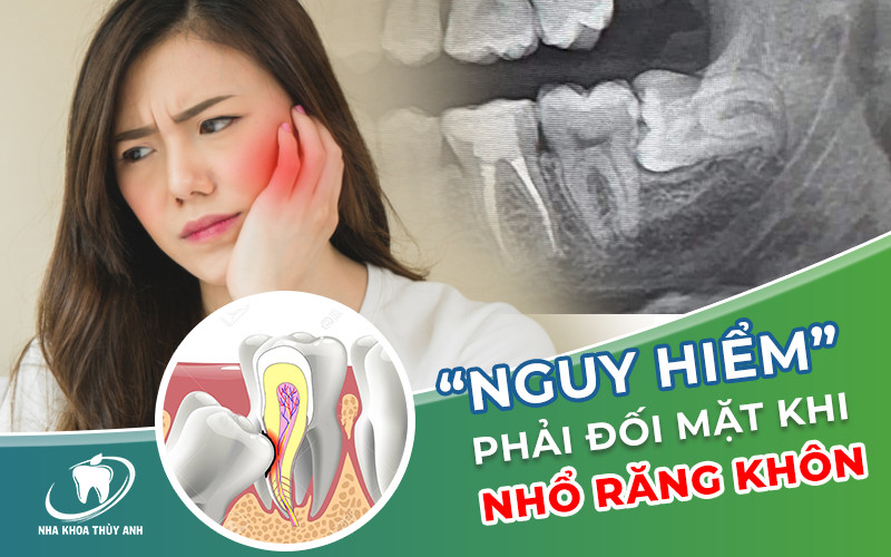 Nguy hiểm khi nhổ răng khôn bạn phải đối mặt? Tìm hiểu ngay