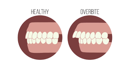 Răng trên phủ răng dưới thế nào là bình thường? Nha khoa Thùy Anh