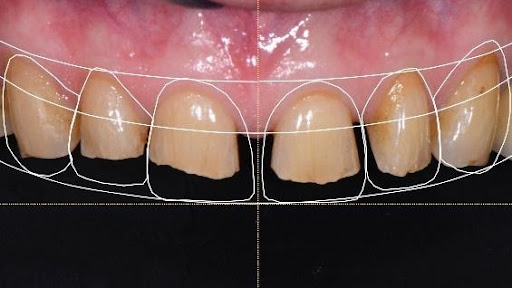 Làm răng sứ phải mài răng như thế nào mới đúng chuẩn? Nha khoa Thùy Anh