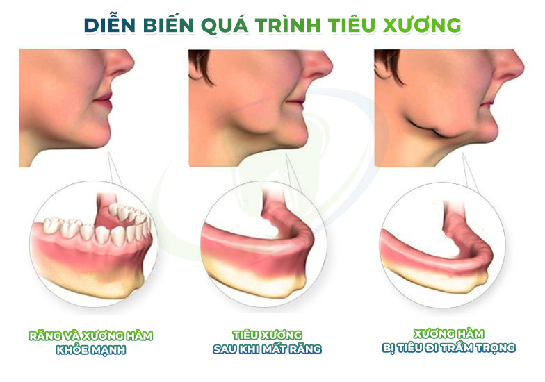 Tại sao người mất răng lại bị móm? Khắc phục bằng cách nào? Nha khoa Thùy Anh