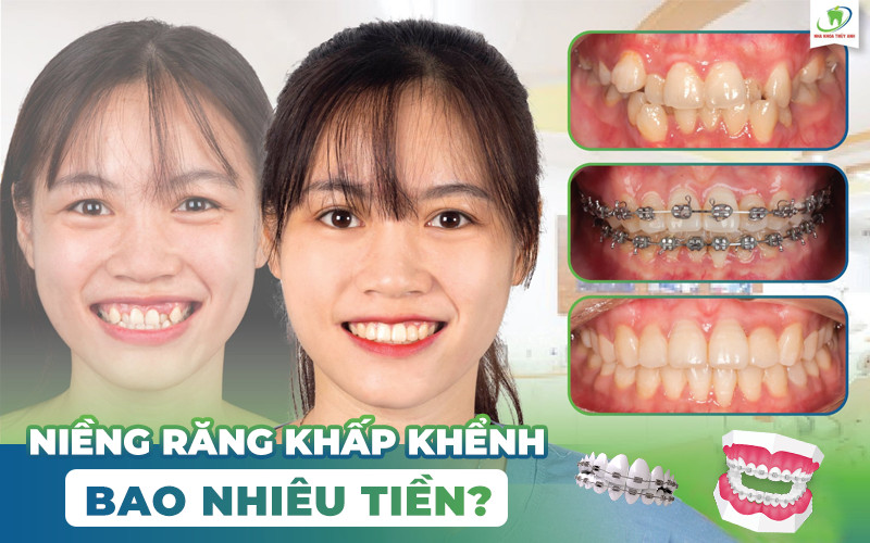 Niềng răng khấp khểnh bao nhiêu tiền? Mức giá niềng răng tốt nhất