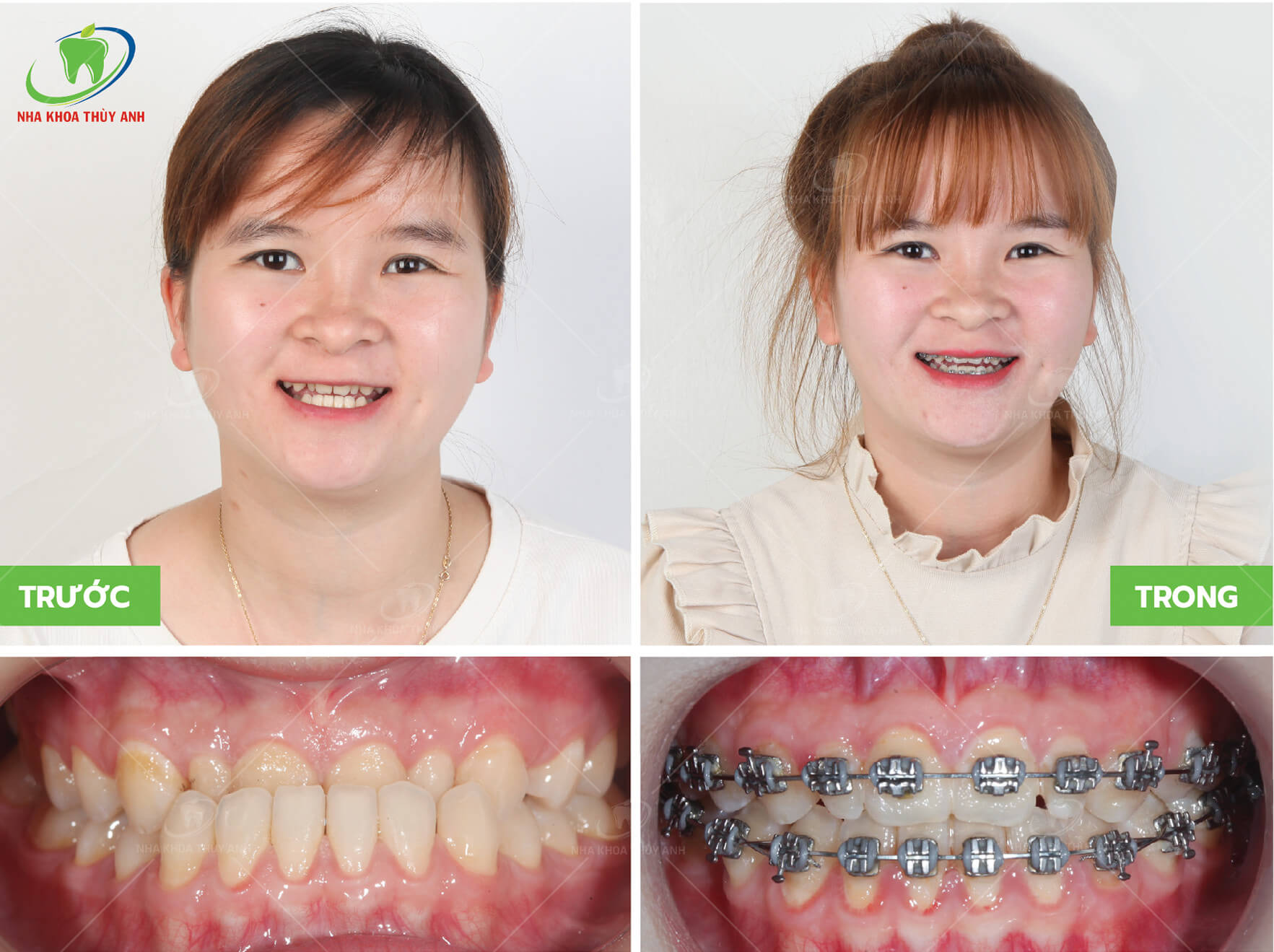 Cách nhận biết case niềng răng khó? Nha khoa Thùy Anh