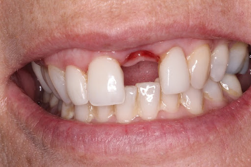 Chức năng của răng cửa là gì? Hậu quả của việc mất răng cửa
