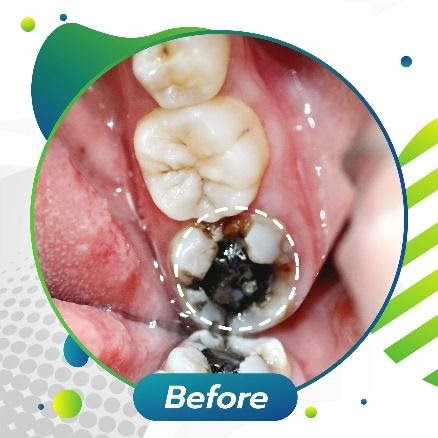 Quy trình hàn răng hàm thường như thế nào?
