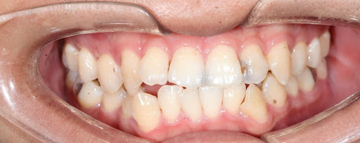 Mewing có chữa được răng khấp khểnh hay không? Nha khoa Thùy Anh