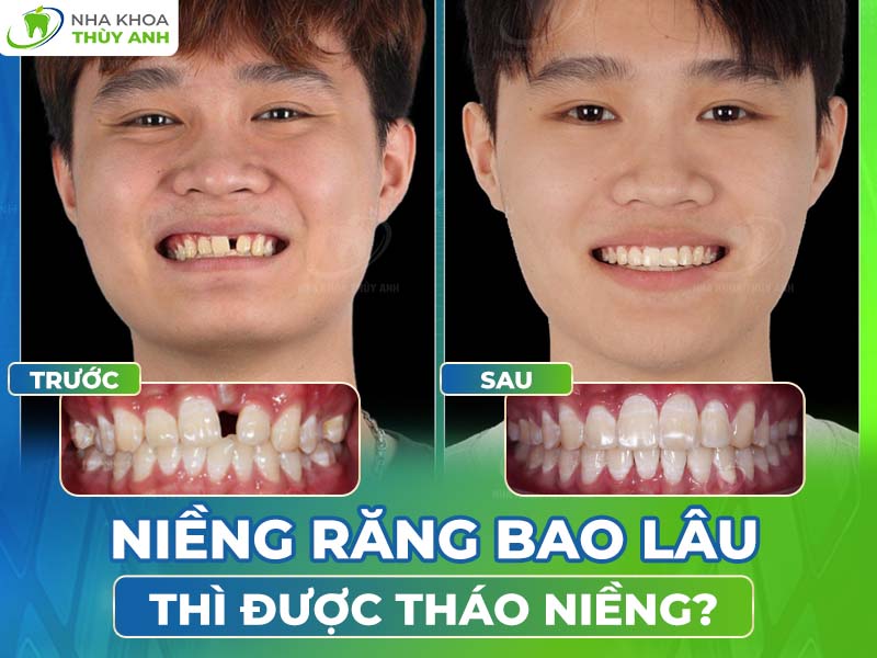 Niềng răng bao lâu thì được tháo? Có nên tháo sớm không?