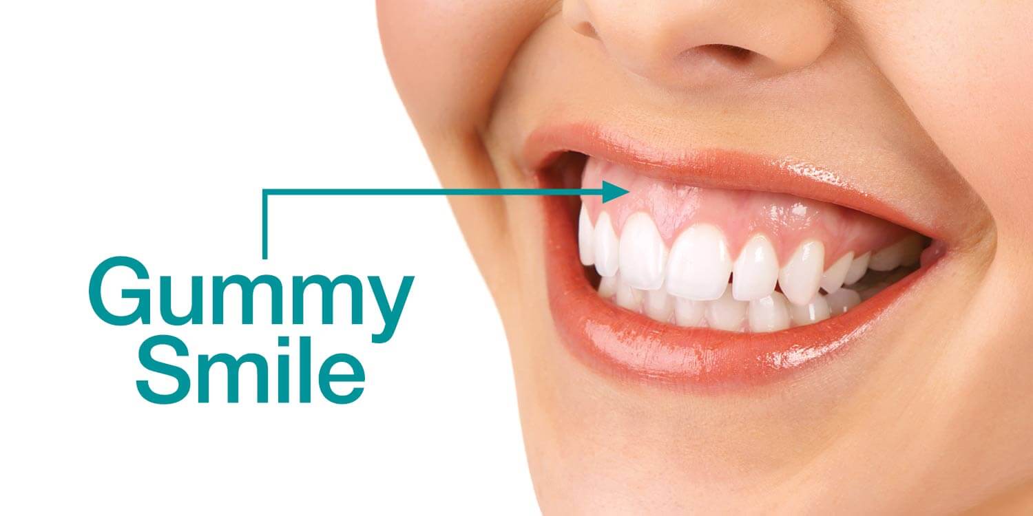 Niềng răng có chữa được cười hở lợi không?