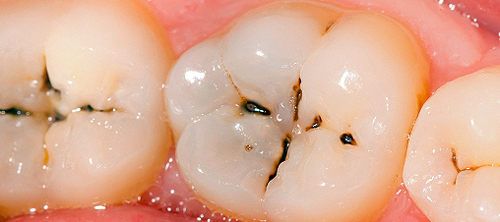 Hàn răng mất bao lâu cho một răng sâu bình thường?