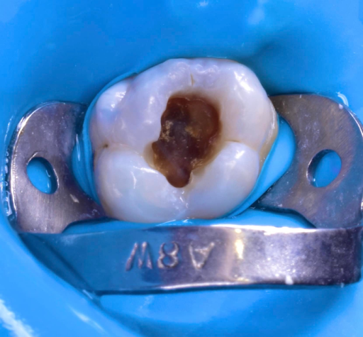 Bạn buộc phải chọn nhổ răng khi gặp những tình trạng này – nha khoa Thùy Anh