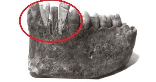 Tìm hiểu về lịch sử hình thành trụ implant – phục hình răng mất