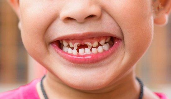 Những vấn đề về sức khỏe răng miệng thường gặp ở trẻ nhỏ