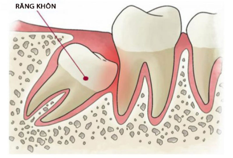Quá trình mọc răng khôn mất bao lâu?
