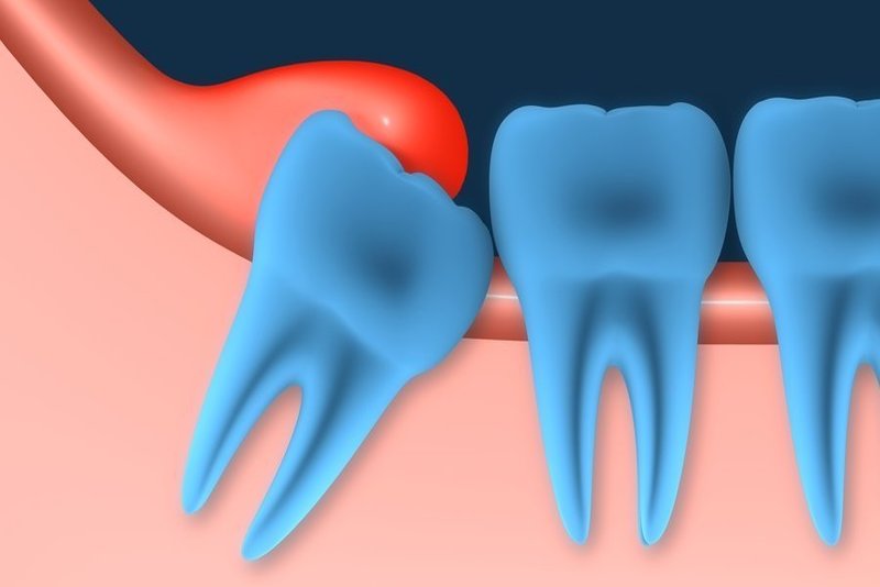 Răng khôn mọc bị lợi trùm: Dấu hiệu và biến chứng bạn cần nắm rõ