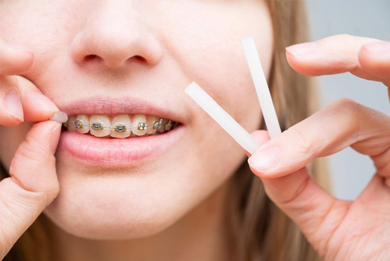 Cách sử dụng sáp nha khoa: Mẹo cực hay để giảm đau khi niềng răng