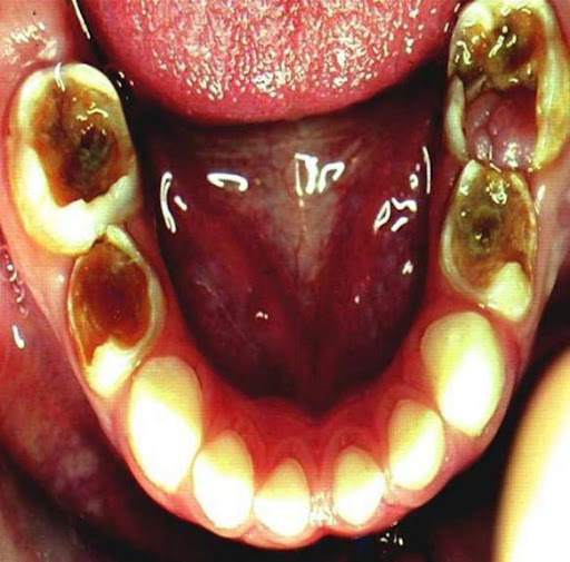 Răng tủy hoại tử có được điều trị theo quy trình điều trị tủy răng sữa hay không?

