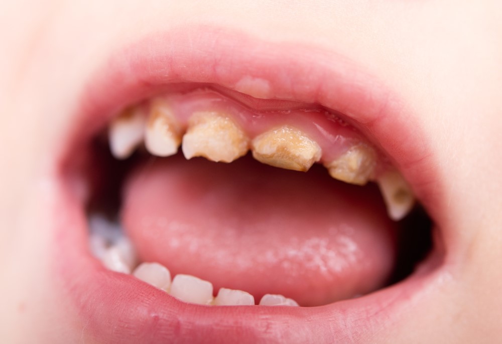 Trẻ bị sâu răng hàm có mọc lại không