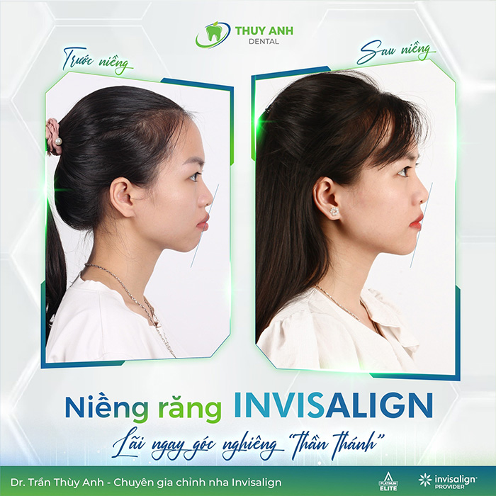 nieng-rang-invisalign-1c