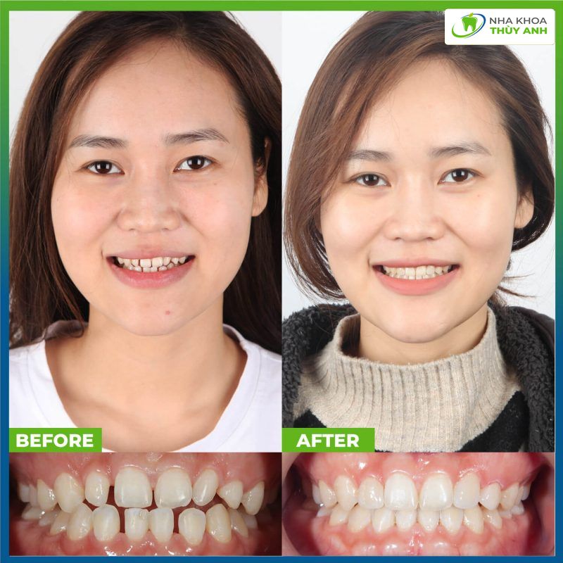 nieng-rang-invisalign-2