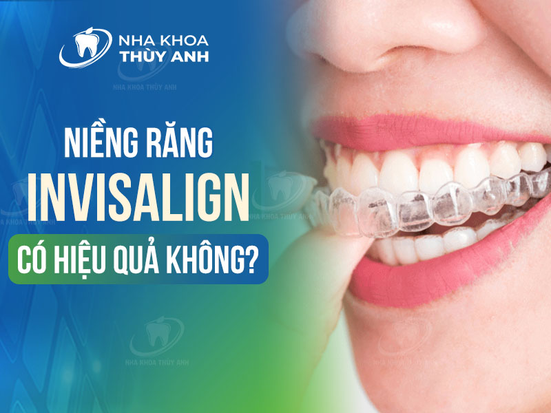 Niềng răng invisalign có hiệu quả không? Nghiên cứu nào chứng minh?