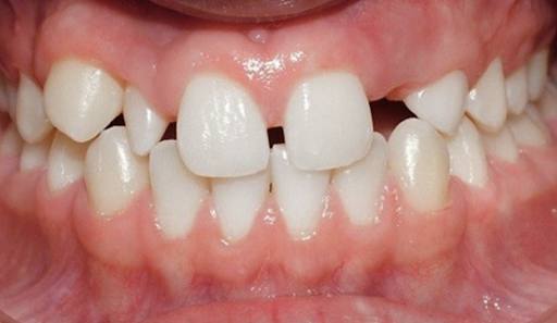 Hỏi đáp: Tại sao niềng răng thưa thường hay bị tái phát?