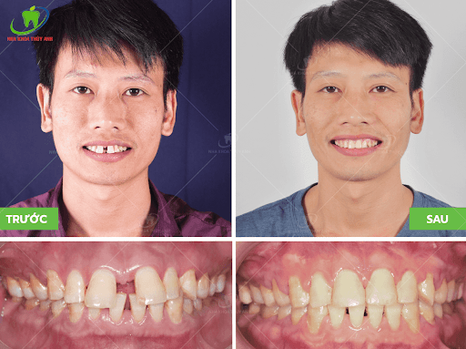 Hỏi đáp: Tại sao niềng răng thưa thường hay bị tái phát ...