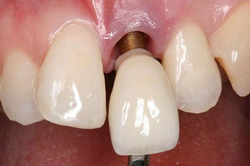 Răng implant lỏng sau lắp nguyên nhân do đâu? Khắc phục như thế nào?