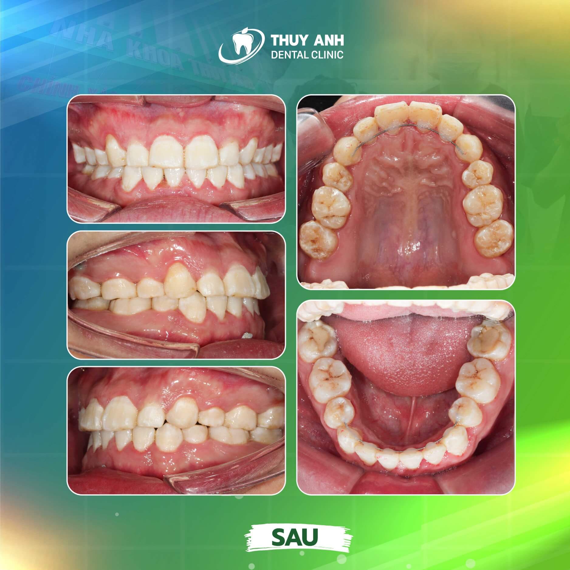 ham-duy-tri-sau-nieng-rang-1 (1)