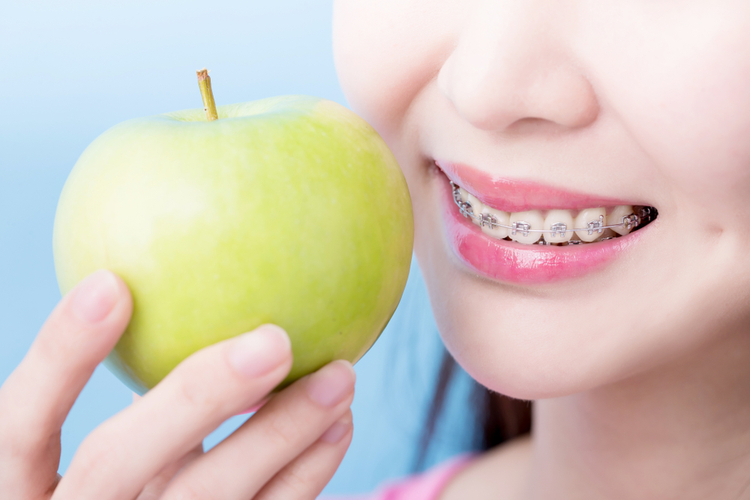 Niềng răng nên ăn gì để không bị bung tuột mắc cài và không bị hóp má?