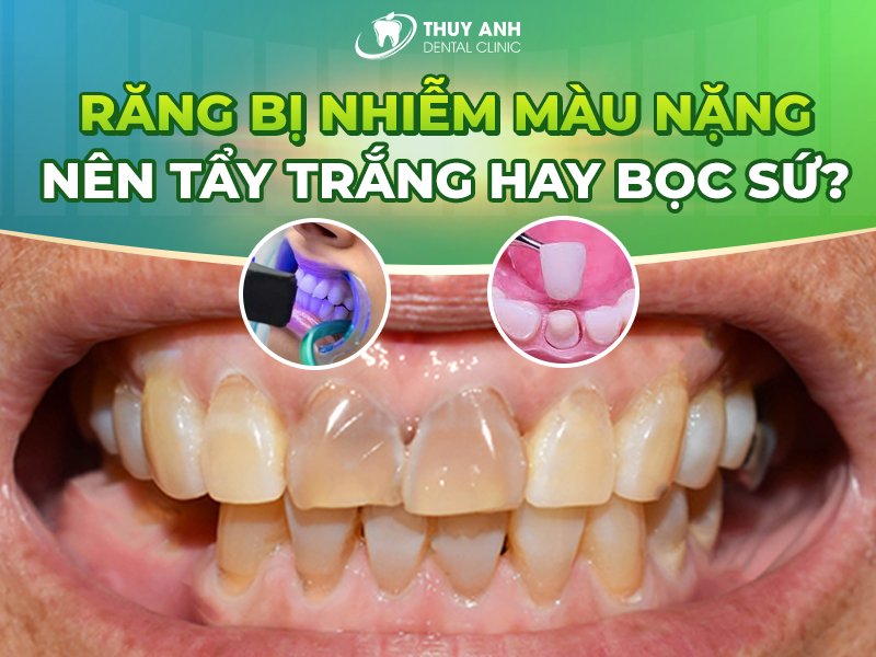 Răng bị nhiễm màu nặng nên tẩy trắng hay bọc sứ? Nha khoa Thùy Anh