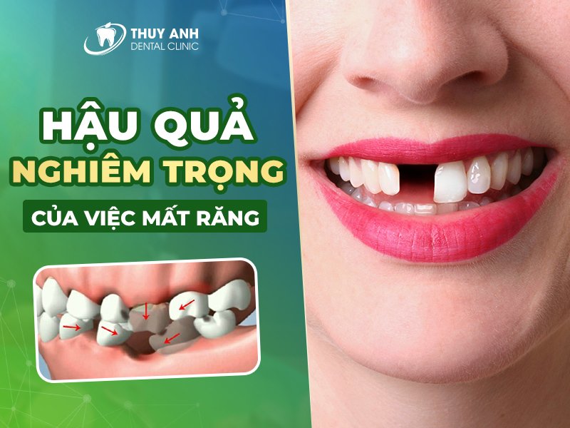 Tất tần tật hậu quả của mất răng bạn cần nắm rõ