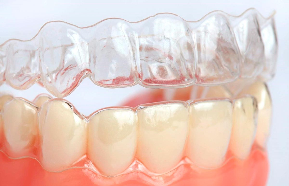 Niềng răng trong suốt loại nào tốt nhất? Gói nào phù hợp với bạn?