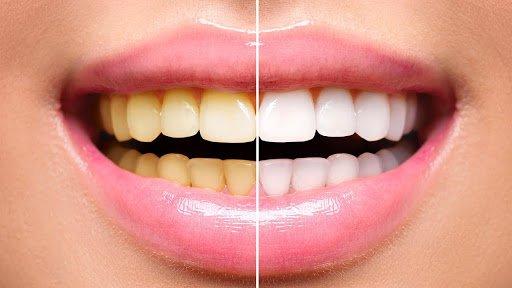 6 thực phẩm khiến răng ố vàng và các mẹo giúp răng trắng sáng