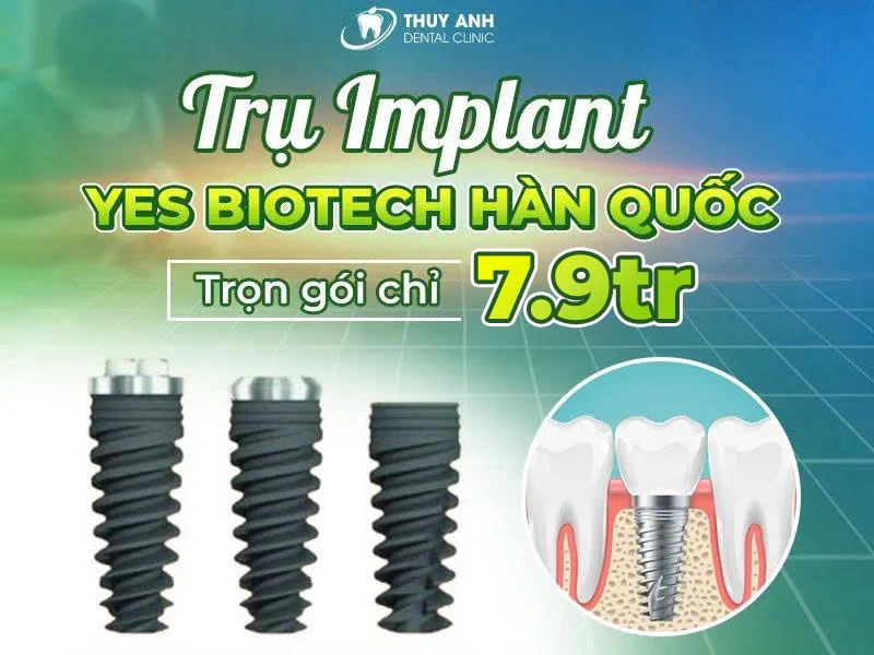 Trụ implant yes biotech có xuất xứ từ đâu? Có tốt không?