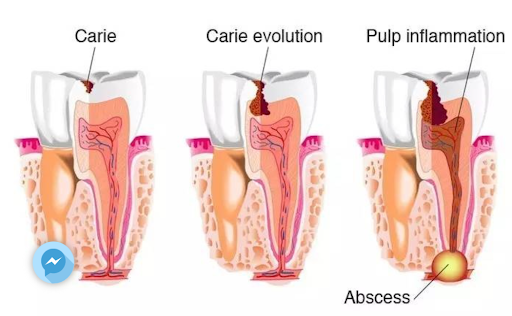 Tủy răng hoại tử là như thế nào? Cách điều trị ra sao?