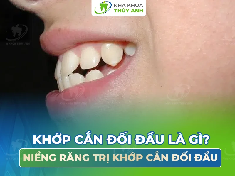 Khớp cắn đối đầu là gì? Cách điều trị khớp cắn đối đầu