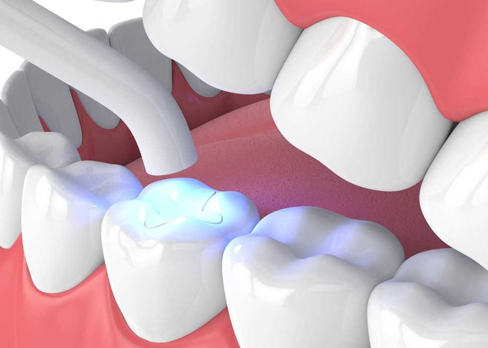 Hàn răng có bền không? Các vật liệu dùng để hàn răng
