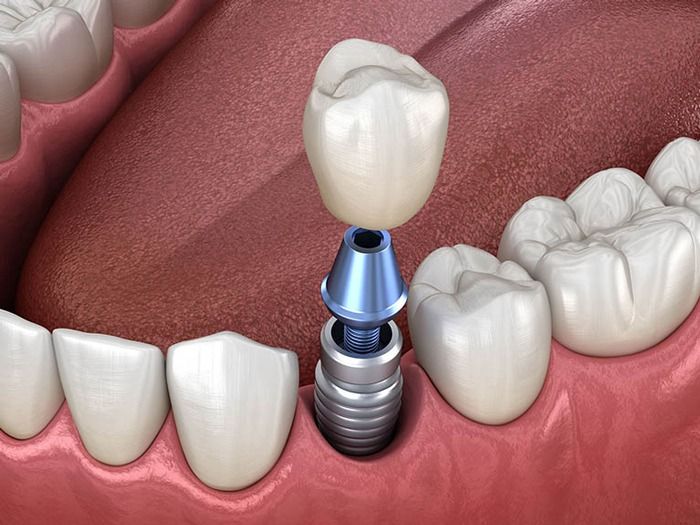 Răng trên trụ implant bị kênh vướng gây hậu quả gì? Khắc phục như thế nào?