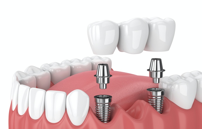 Trồng răng implant bắt vít là gì? Lợi ích của implant bắt vít