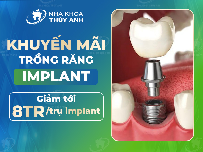 Trồng răng implant khuyến mãi tới 8 triệu đồng cho dòng trụ implant cao cấp