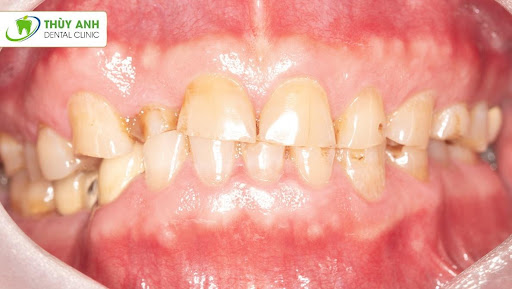 Mòn răng trầm trọng phục hồi như thế nào hiệu quả?