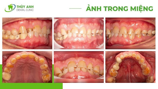 Tại sao có những hàm răng nhai mãi không mòn lại có hàm răng mòn trầm trọng?