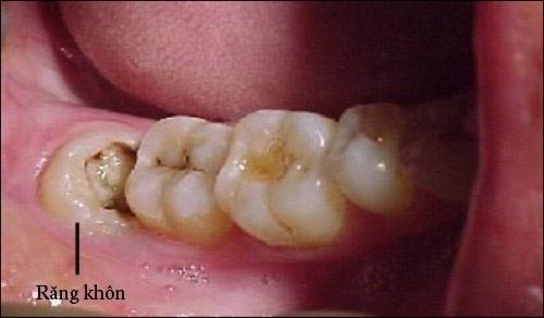 Nhổ răng khôn mọc lệch đối diện nguy hiểm nào? Nha khoa Thùy Anh