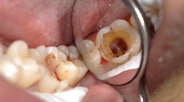 Trường hợp nào nên nhổ răng số 6 bị sâu? Nha khoa Thùy Anh