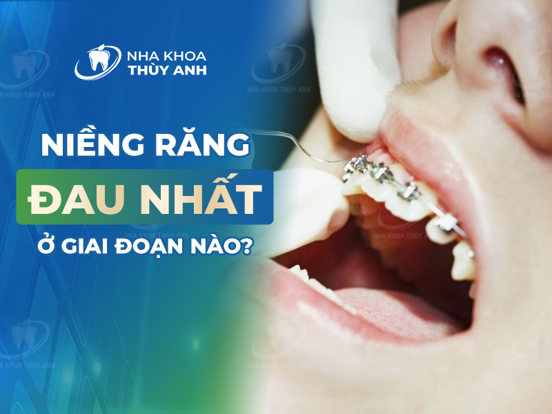 Trong quá trình niềng răng thì đau nhất giai đoạn nào?