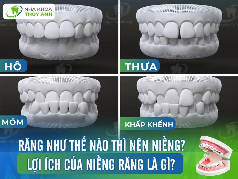 Răng như thế nào thì nên niềng? Lợi ích của niềng răng là gì?