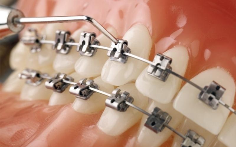 Niềng răng mắc kim loại: An toàn, hiệu quả và tiết kiệm