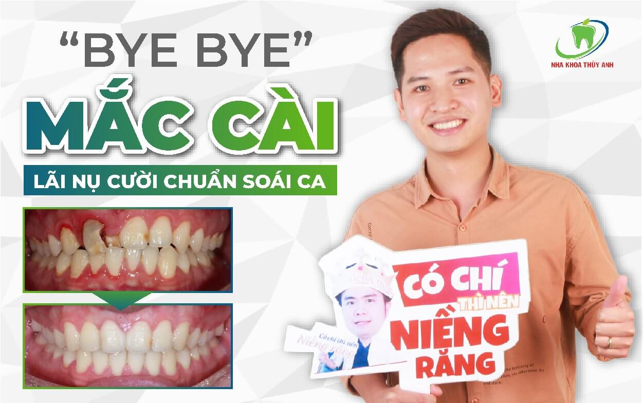 Tạm biệt răng kẹ “xấu xí” – đón chào sự “đẹp trai” với hàm răng đều đặn sau 2 năm rưỡi kiên trì niềng răng
